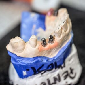 ¿Cuánto duran los implantes dentales?