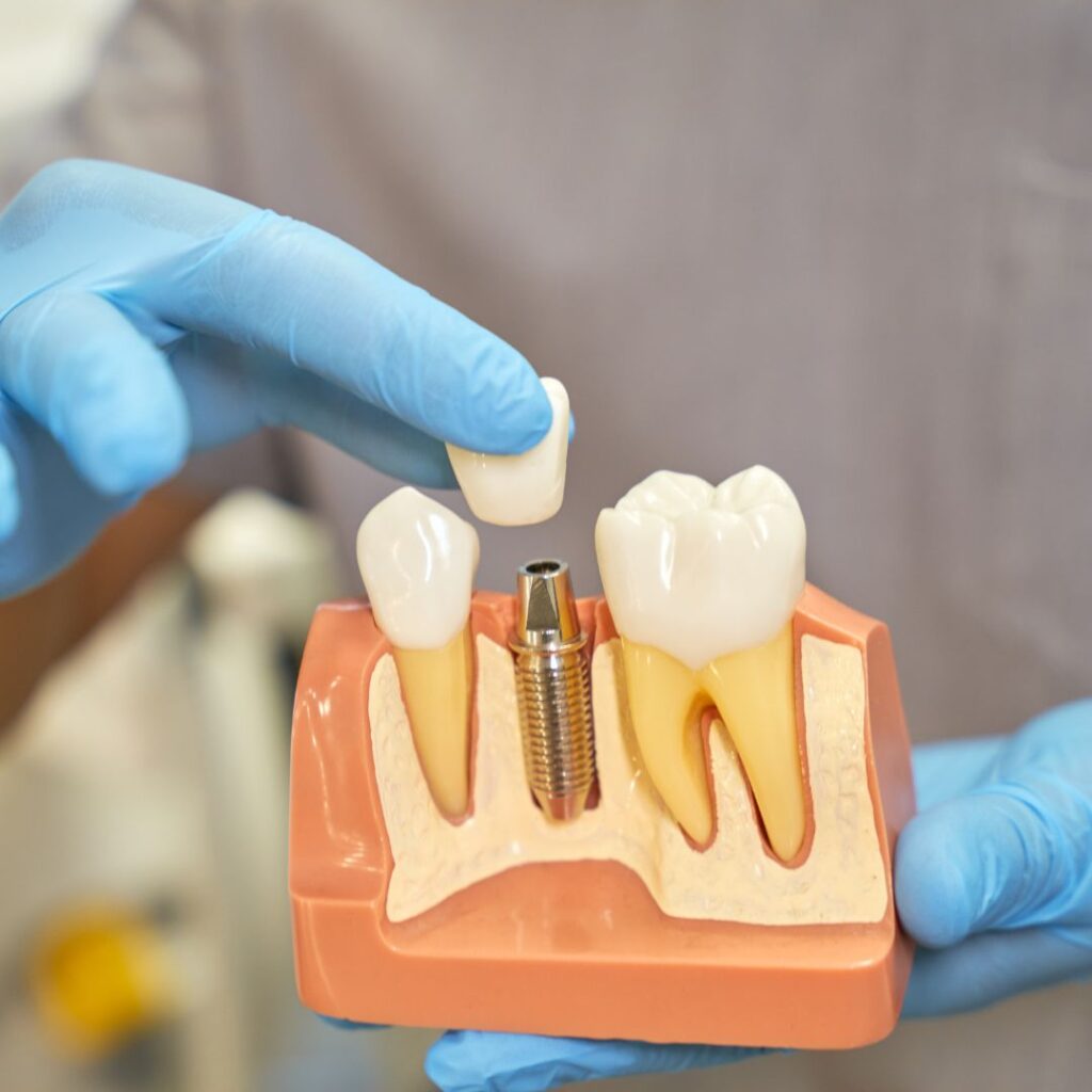 implante dental fallido